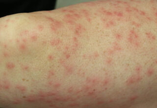 صورة المصالح الصحية في المغرب تعلن “مرض بوحيمرون “وباءا وتسنتفر أجهزتها